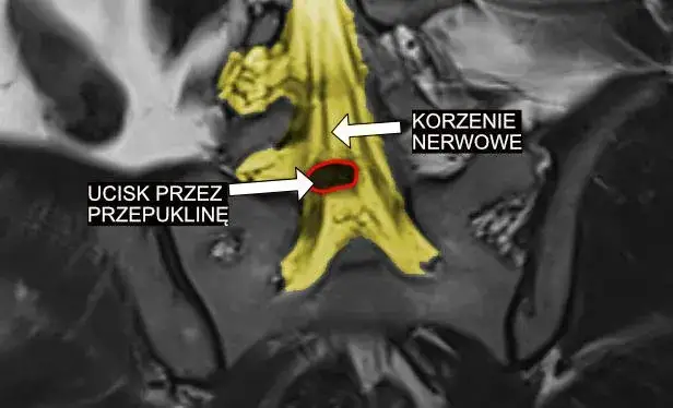 G54 - najpowszechniejsze objawy choroby korzeni i splotów nerwowych