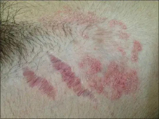 Skuteczne sposoby na pryszcze po sterydach - jak leczyć skutki stosowania