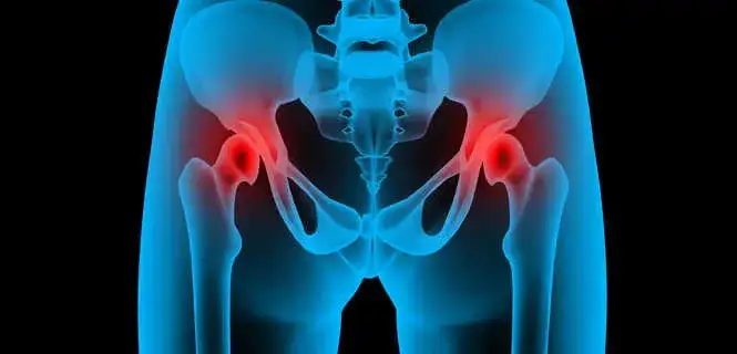 Jakie endoprotezy stawu biodrowego refunduje NFZ i co warto wiedzieć