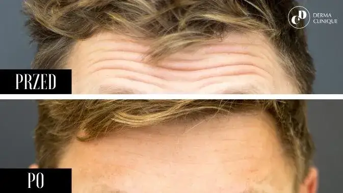 Botoks: Ból czy dyskomfort? Pełny przewodnik po odczuciach.