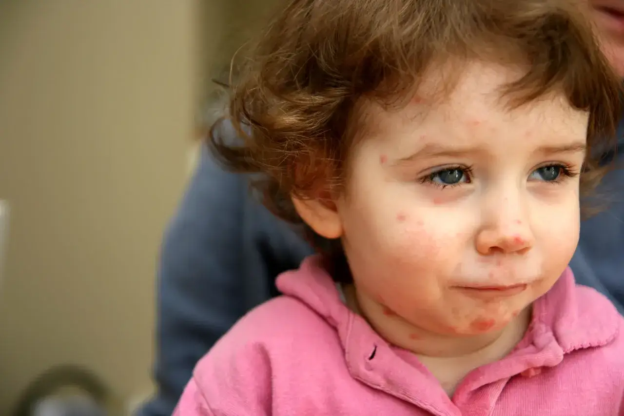 Skuteczne metody leczenia ospy w jamie ustnej i łagodzenia bólu