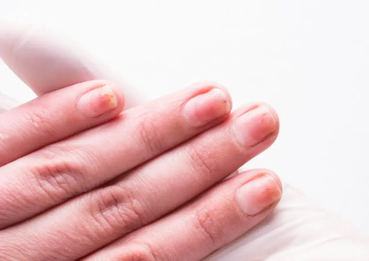 Jak skutecznie leczyć onycholizę po hybrydzie i uniknąć bólu