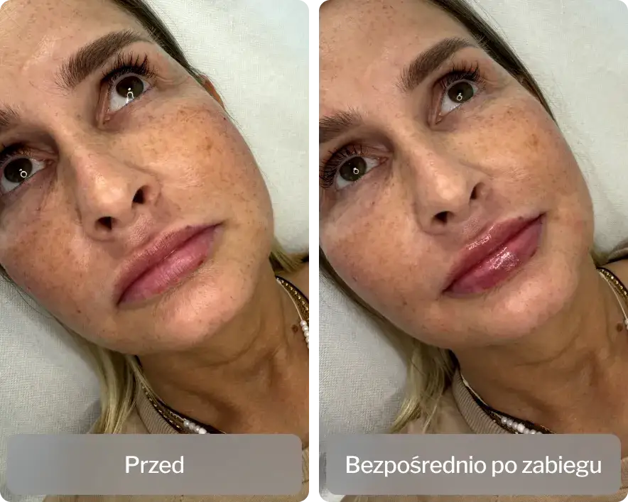 Co robi kwas hialuronowy i jak może odmłodzić Twoją skórę?