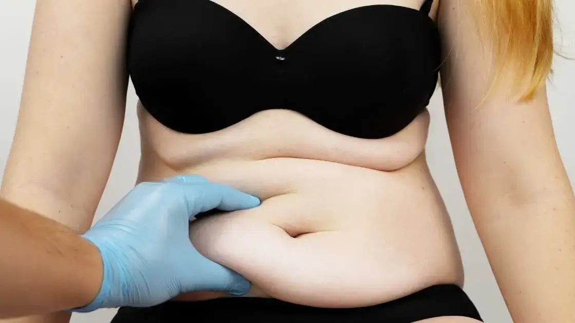 Plastyka brzucha NFZ gdzie uzyskać refundację i uniknąć kosztów