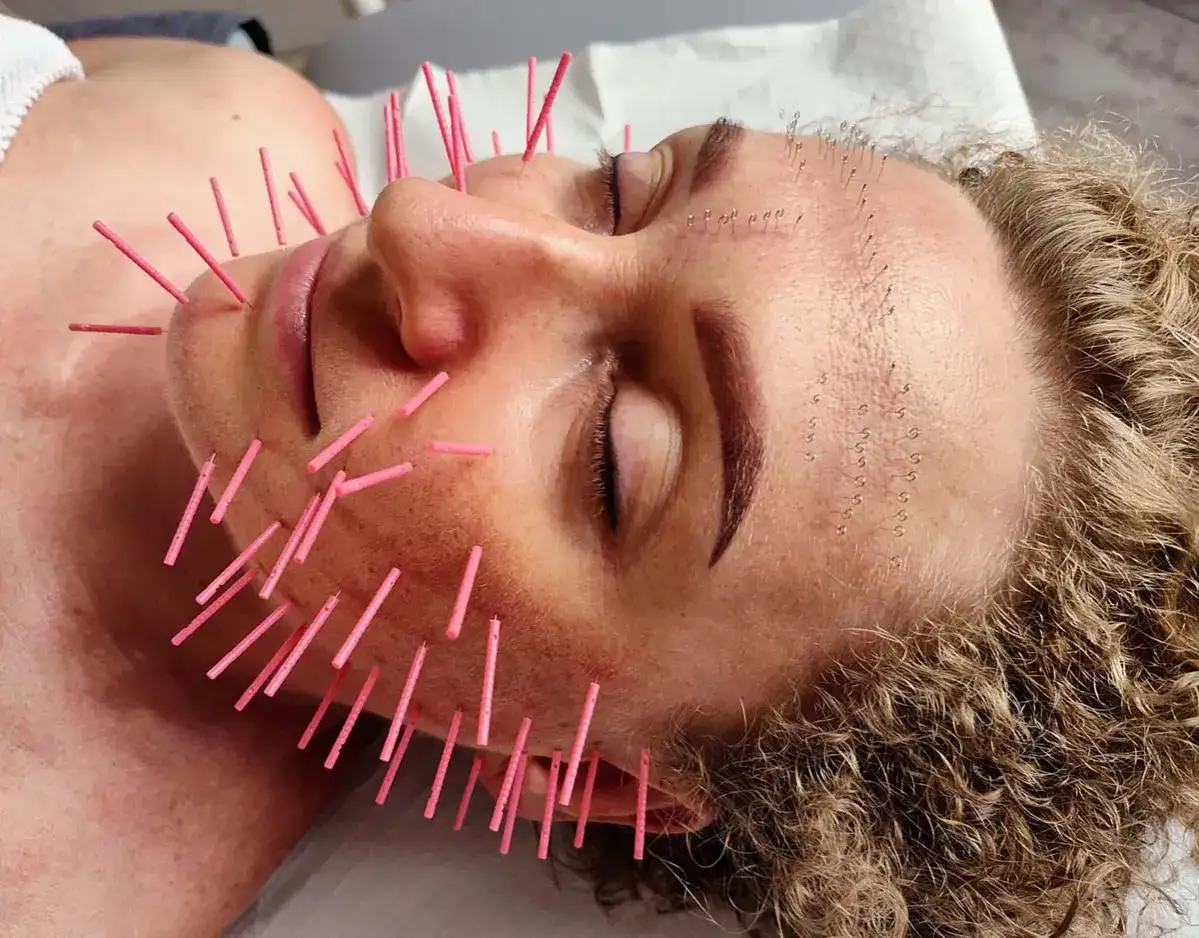 Akupunktura twarzy: Ile kosztuje naturalny lifting? Cennik i efekty
