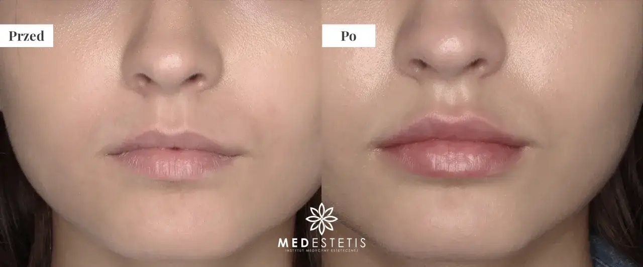 Powiększanie ust: Ile trwa zabieg, gojenie i trwałość efektów?