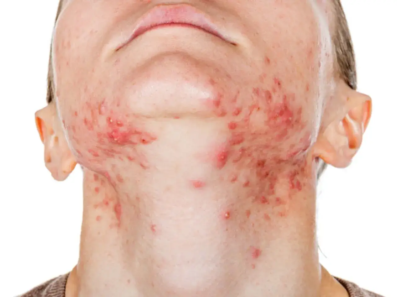 Pryszcze na brodzie: Rozpoznaj przyczyny hormony, dieta, nawyki