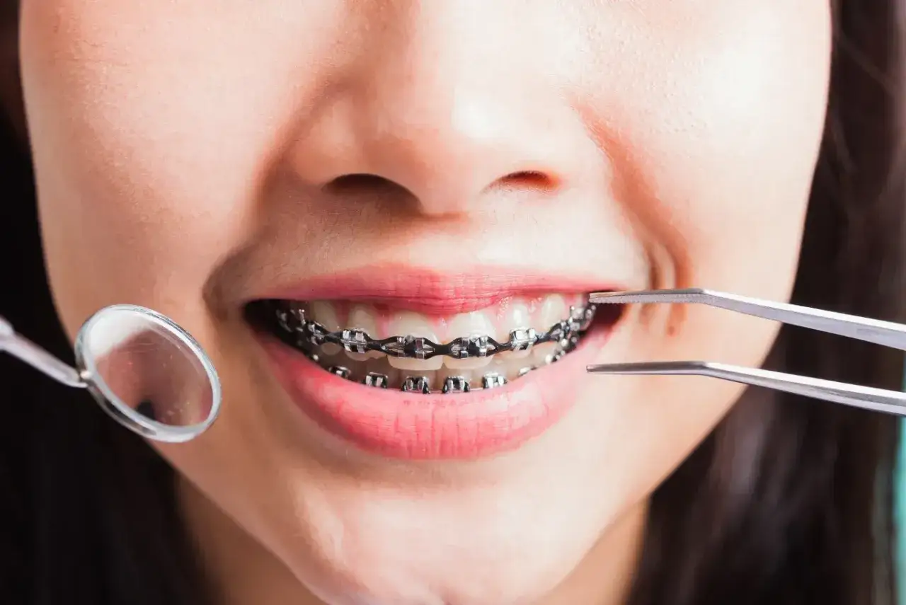 Uśmiechnięta twarz dziecka z aparatem ortodontycznym. Ortodonta na NFZ dla dzieci to szansa na piękny uśmiech.