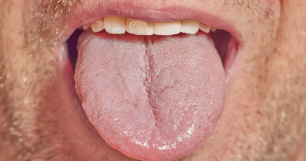 Zapalenie jamy ustnej: Objawy? Rozpoznaj sygnały i działaj!