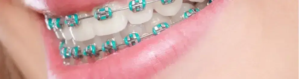 Aparat ortodontyczny: Zakładanie bez bólu? Przewodnik krok po kroku