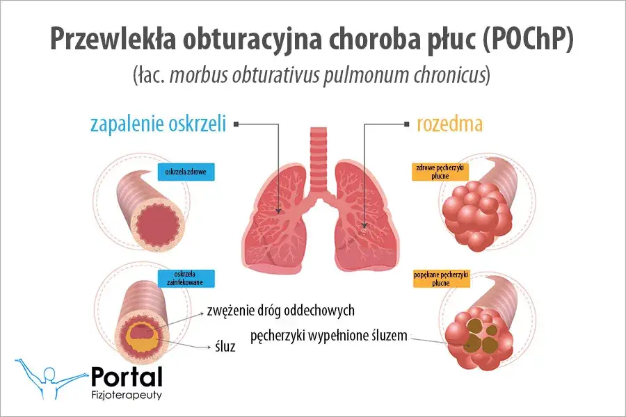 POChP a klimat: Gdzie szukać ulgi i jak oddychać lepiej?