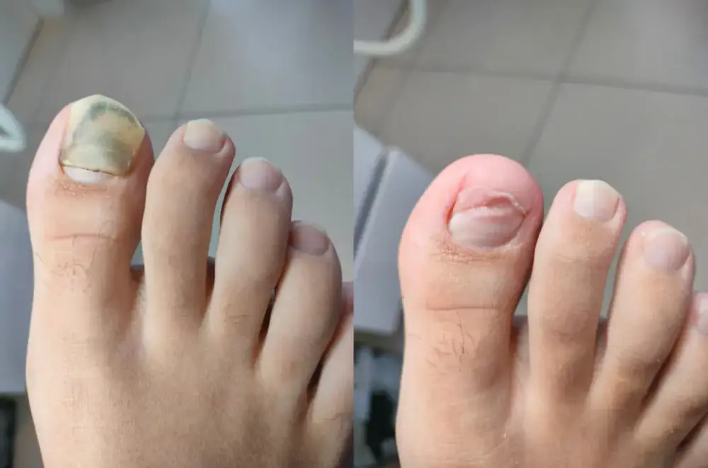 Jak długo boli zbity paznokieć? Sprawdź, co musisz wiedzieć