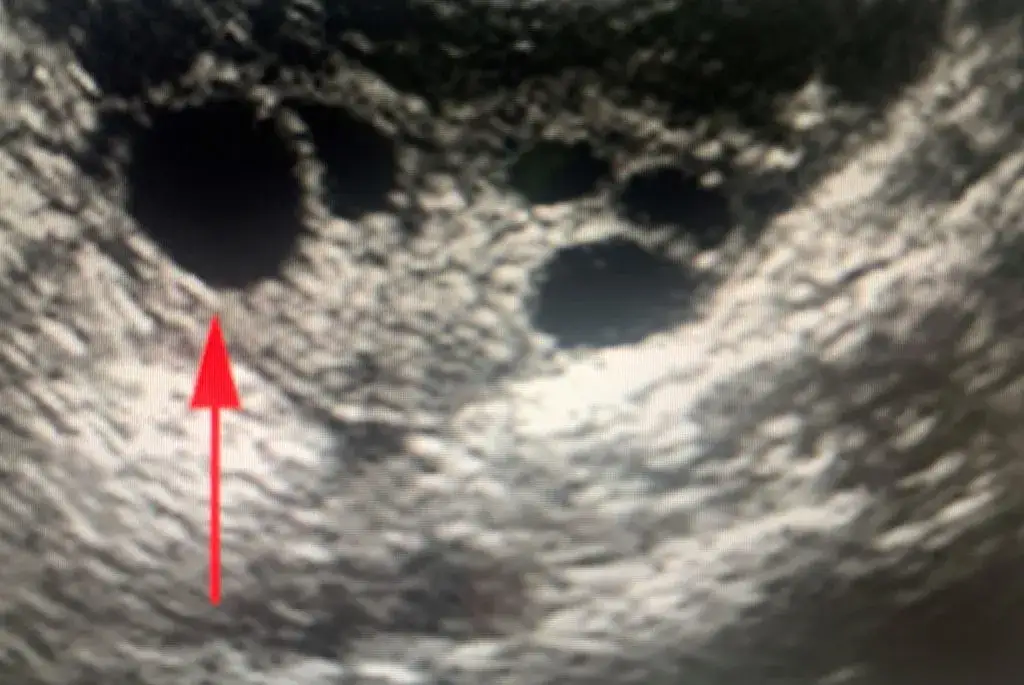 Czy na USG widać owulację? Pewne znaki na ekranie