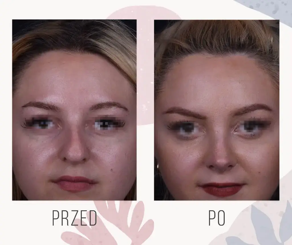 Jak zmniejszyć nos kwasem hialuronowym - efekty, bezpieczeństwo i ryzyko