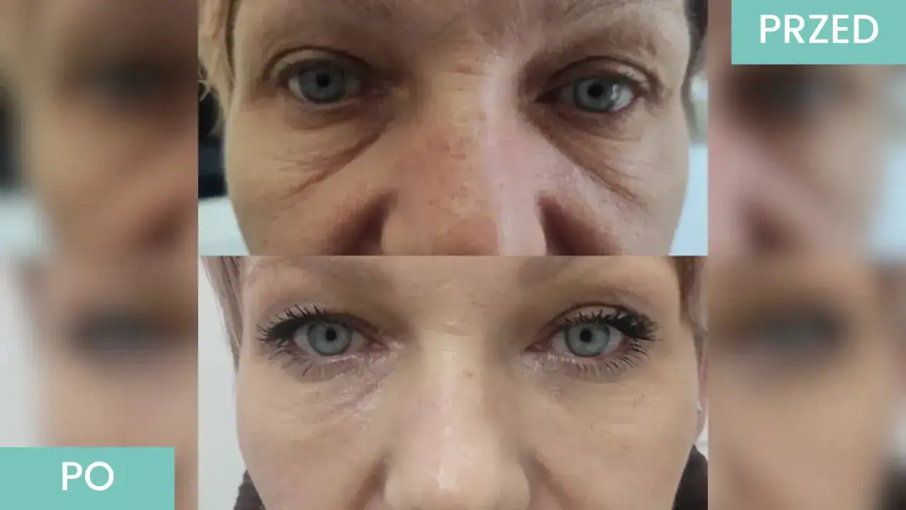 Przed i po zabiegu stymulatorami tkankowymi pod oczy. Zmarszczki wokół oczu są mniej widoczne, bez widocznych skutków ubocznych.