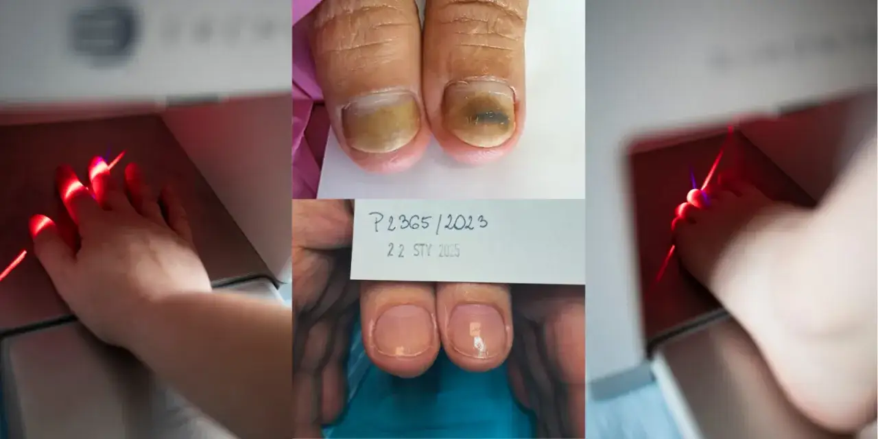 Grzybica paznokci: Od lakieru po laser co wyleczy ją na stałe?