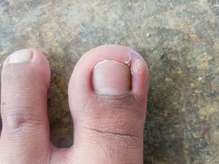 Jak wygląda wrośnięty paznokieć? Objawy i skutki, które musisz znać