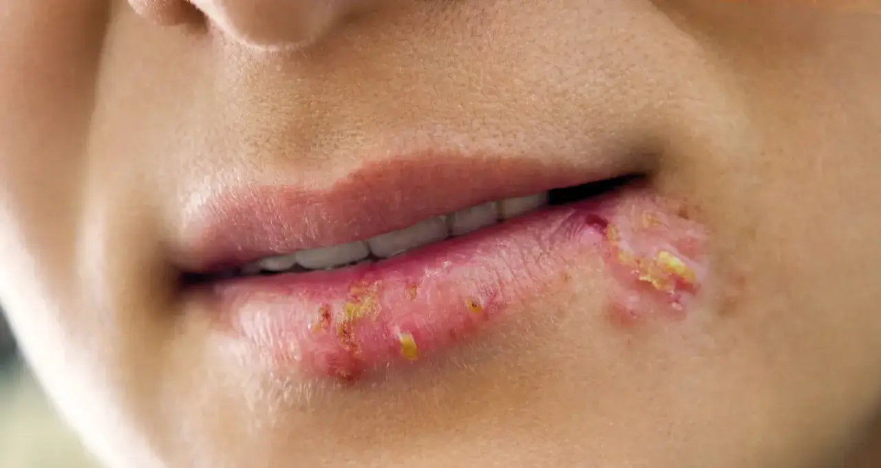 Opryszczka: 5 filarów profilaktyki. Zapanuj nad wirusem!