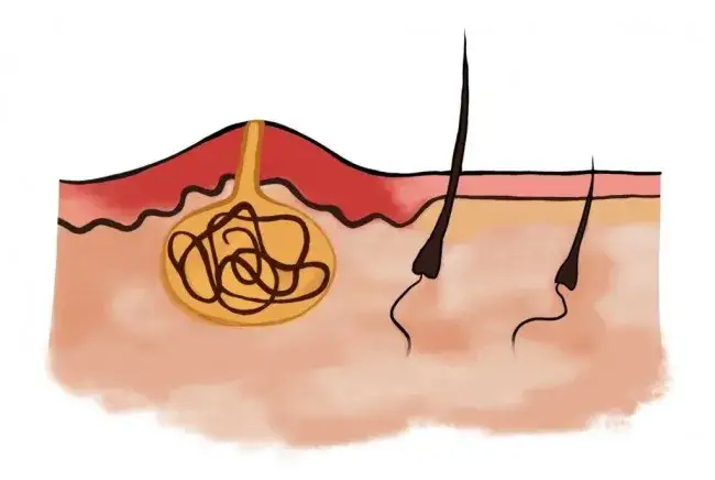 Torbiel włosowa: do jakiego lekarza się udać, aby uniknąć powikłań?