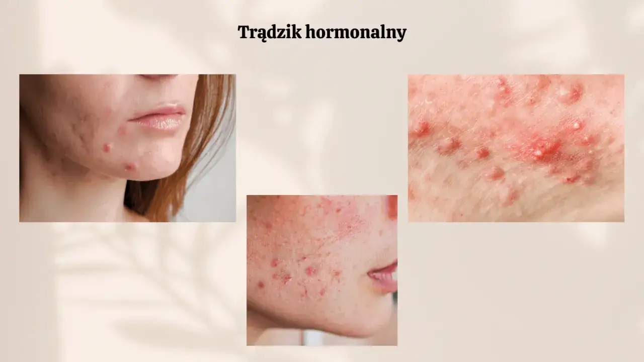 Badania hormonalne na trądzik: Ceny, NFZ i droga do zdrowej cery