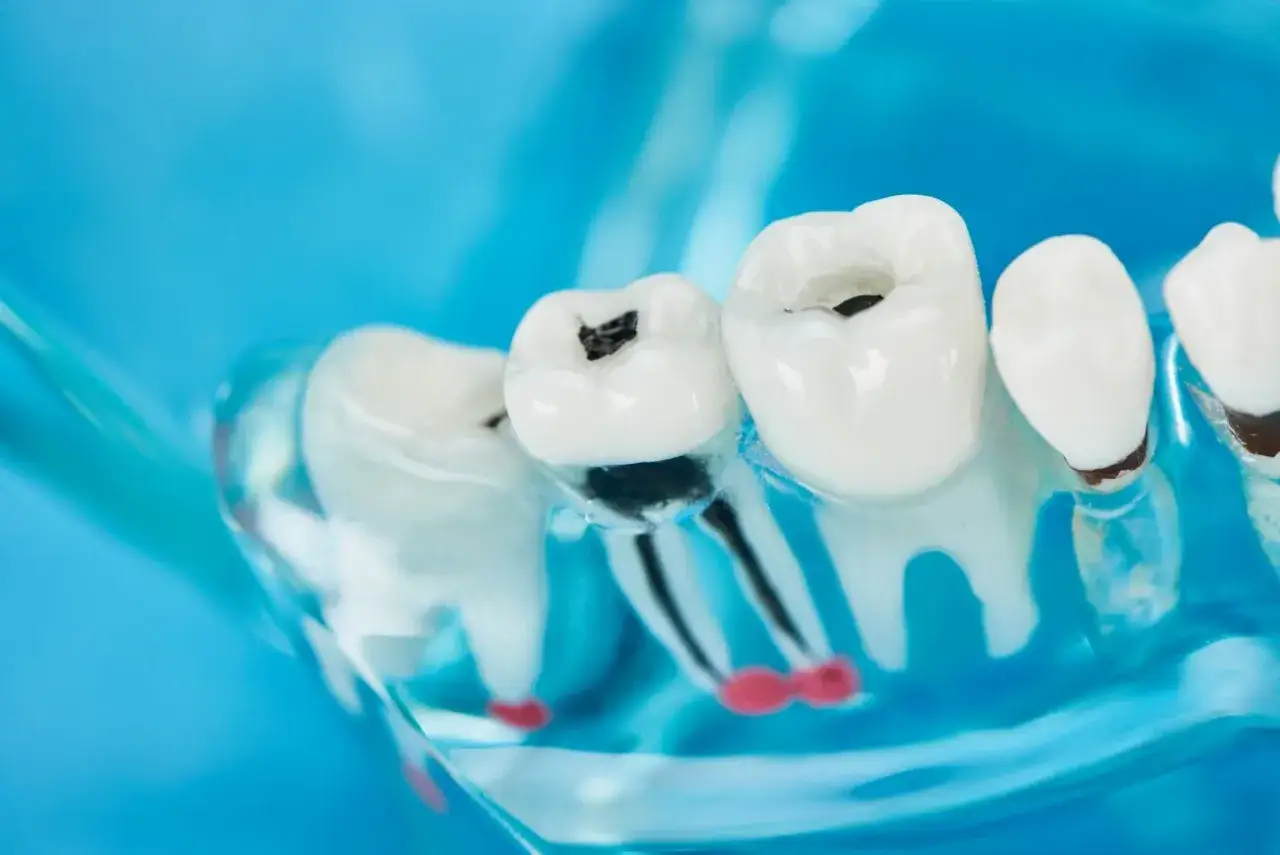 Model szczęki z widoczną próchnicą przy dziąśle. Ciemne ubytki w zębach, widoczne korzenie.