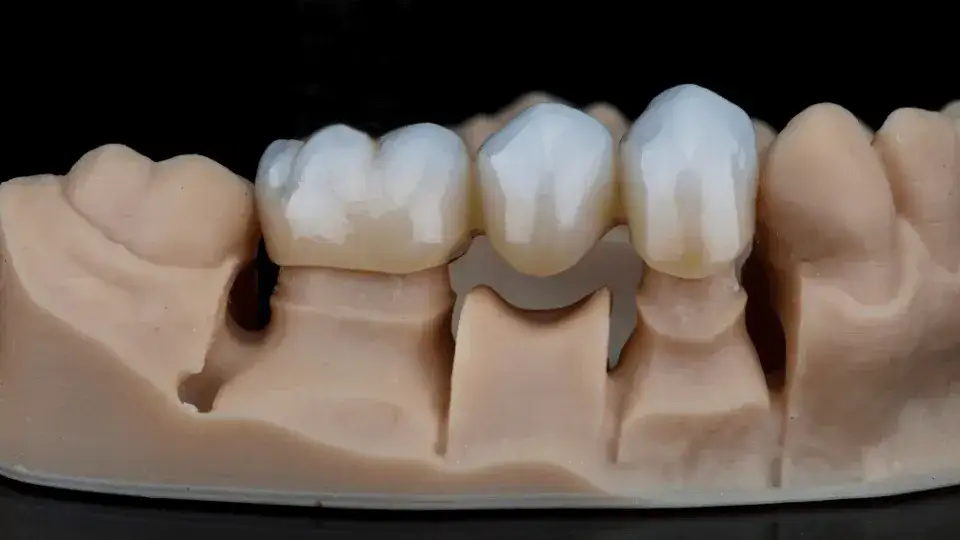 Jak wygląda most protetyczny? Odkryj jego naturalne piękno!