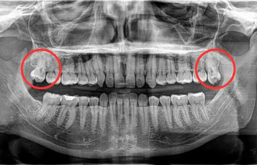 Ile rośnie ząb mądrości? Etapy, objawy i jak uniknąć bólu