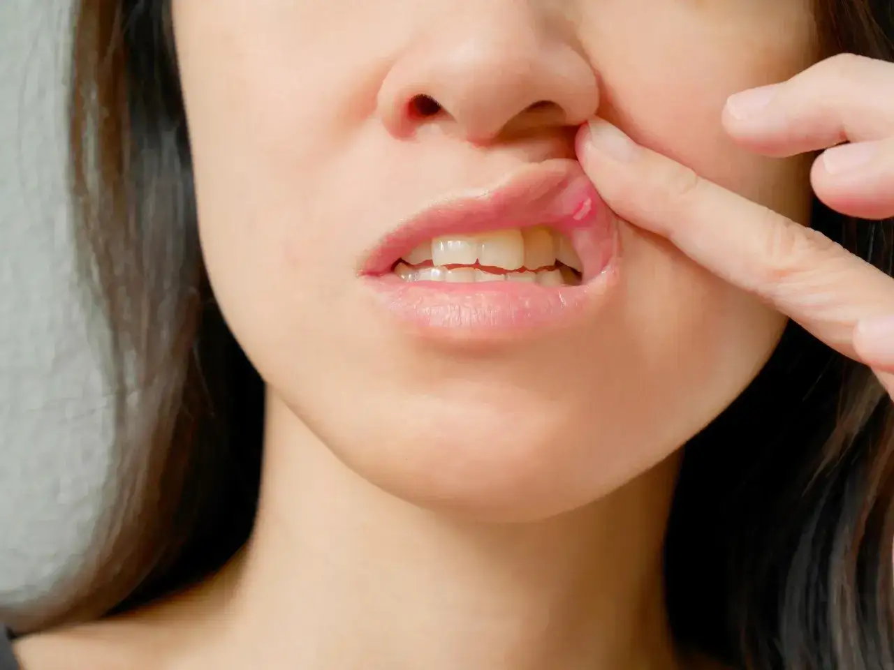 Zbliżenie na usta kobiety z widoczną aftą na dziąśle, którą kobieta odsłania palcem.