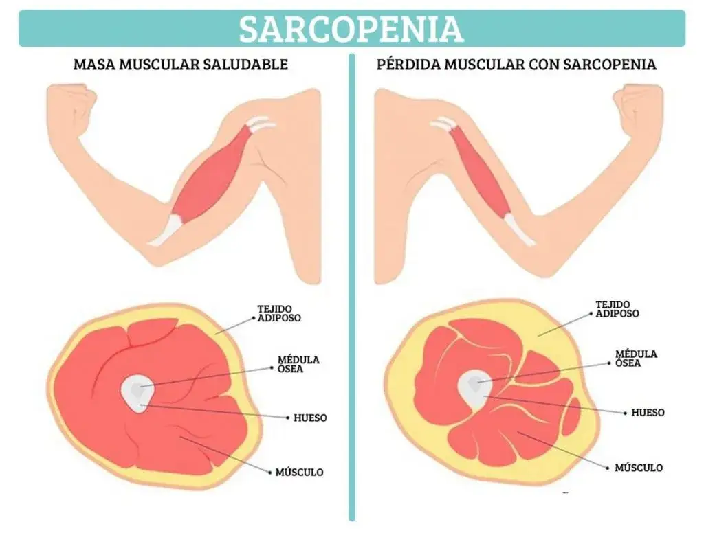 Cómo prevenir la pérdida de masa muscular y mejorar tu calidad de vida