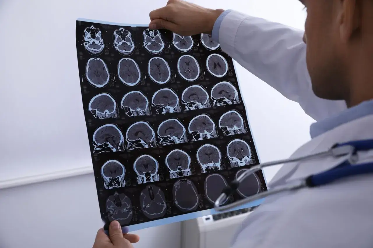 Lekarz analizuje tomografię komputerową głowy, szukając oznak krwiaka mózgu. Obraz pokazuje przekroje mózgu w różnych płaszczyznach.