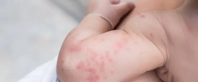 Uczulenie na sierść u niemowląt objawy – jak je rozpoznać i leczyć