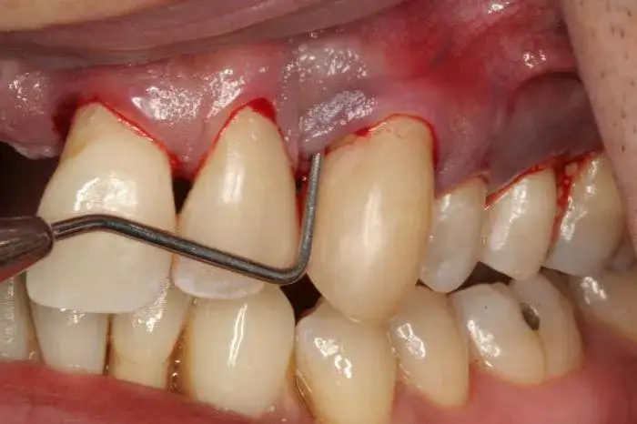 Czy rak dziąsła boli? Objawy, przyczyny i kiedy ból może się pojawić