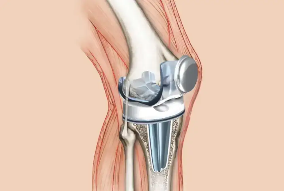Jak długo trwa rehabilitacja po endoprotezie kolana i co warto wiedzieć