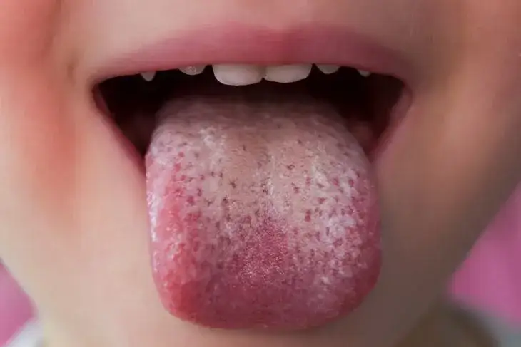 Ile trwa leczenie grzybicy jamy ustnej? Fakty i mity