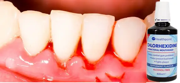 Krwawiące dziąsła? Odkryj domowe sposoby na mocny uśmiech!