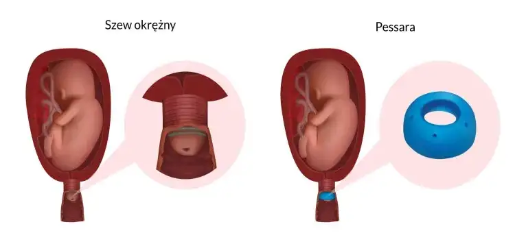 Skracanie szyjki macicy: jak zapobiegać i chronić ciążę?