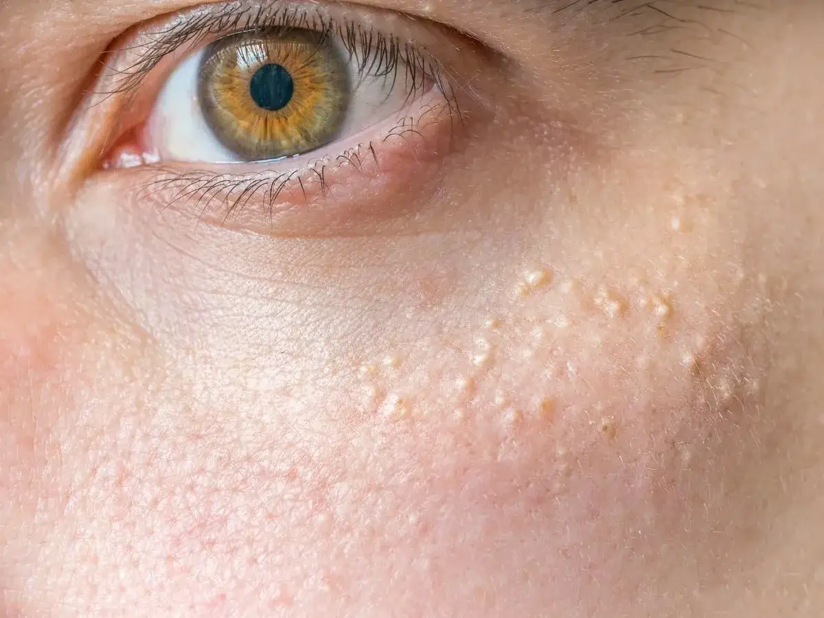 Zbliżenie na skórę twarzy z widocznymi drobnymi, żółtawymi grudkami, które mogą być pytaniem co na kaszkę na twarzy. Widoczne też pory skóry.