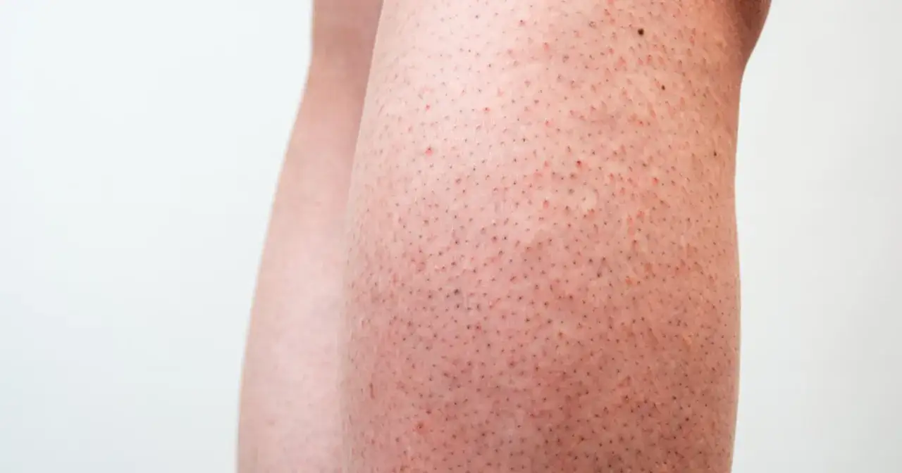 Jak skutecznie pozbyć się czerwonych kropek po goleniu i uniknąć bólu