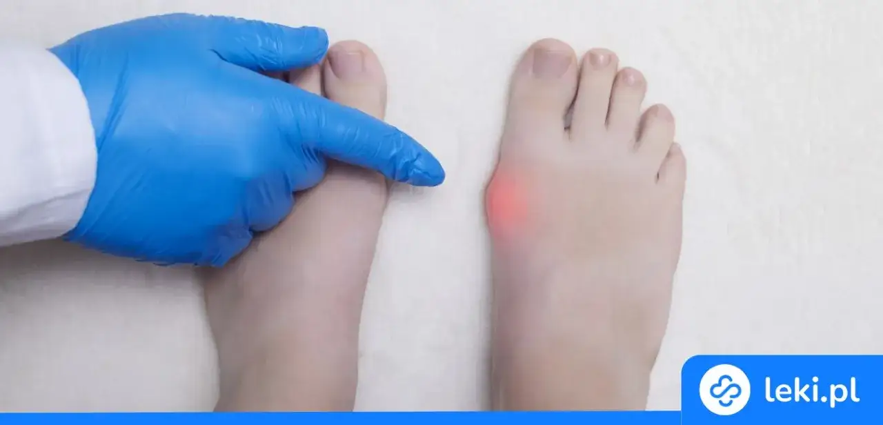 Haluksy: Jak skutecznie złagodzić ból i wyleczyć deformację?