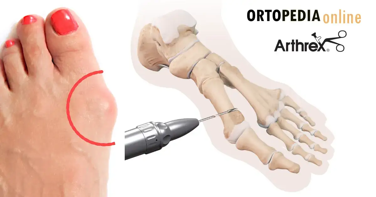 Operacja haluksów: kiedy jest konieczna i czy warto czekać?