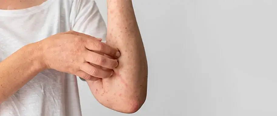 Czy biotyna uczula? Objawy alergii, które warto znać