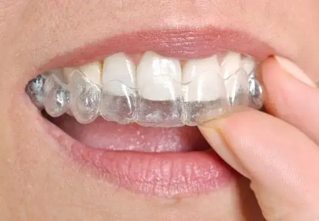 Jaki aparat na zęby wybrać? Porównanie typów, zalety, wady i koszty