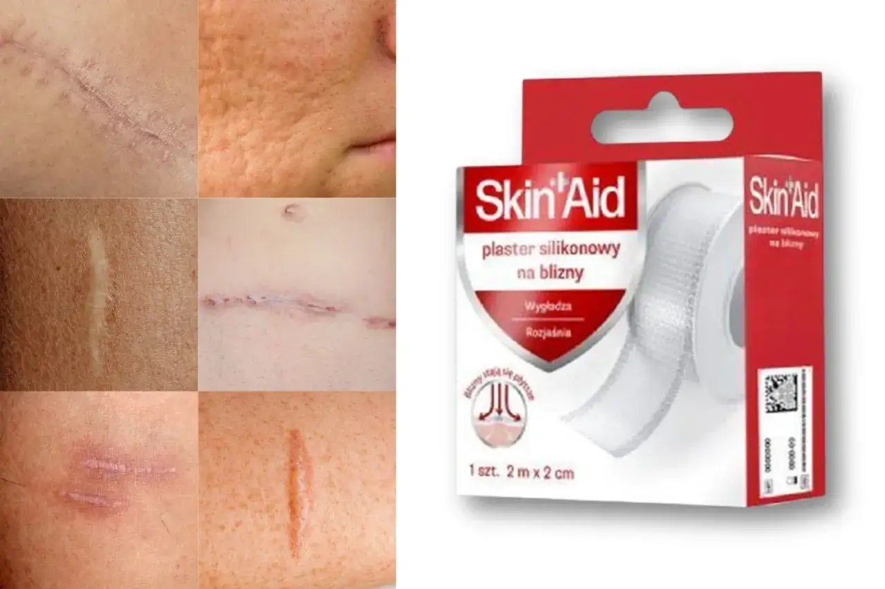 Skin Aid plastry na blizny: Opinie, recenzja i efekty