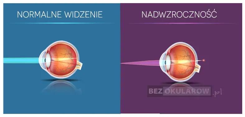 Plusy na recepcie? Zrozum dalekowzroczność i jak ją korygować