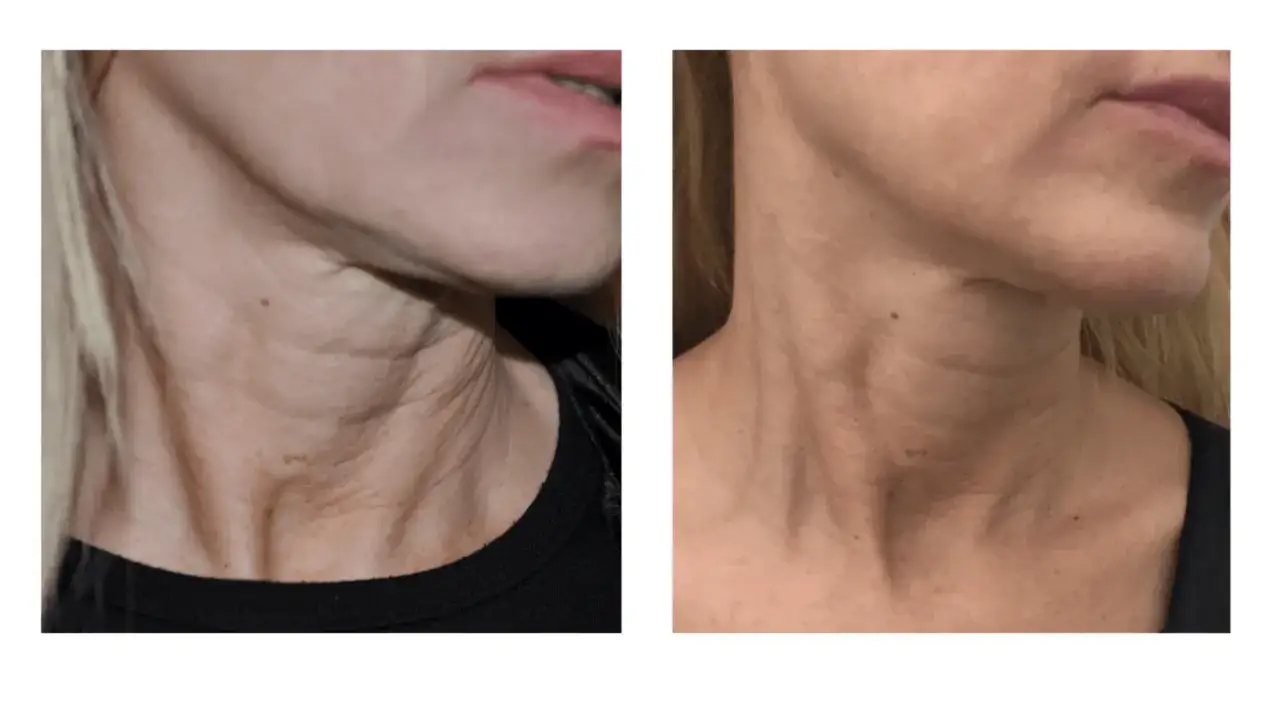 Przed i po zabiegach na szyję: widoczna poprawa napięcia skóry i redukcja zmarszczek na szyi.