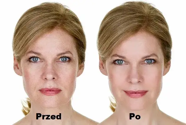 Botoks na kurze łapki – kiedy widać efekty i co wpływa na czas?