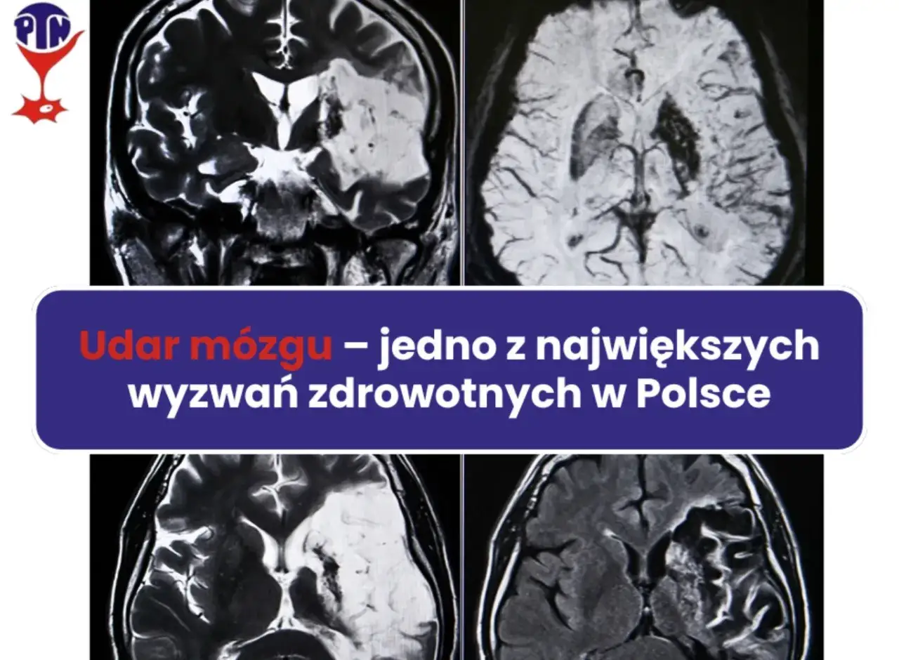 Udar mózgu: Czy umiera się? Kluczowe fakty i nadzieja na życie.