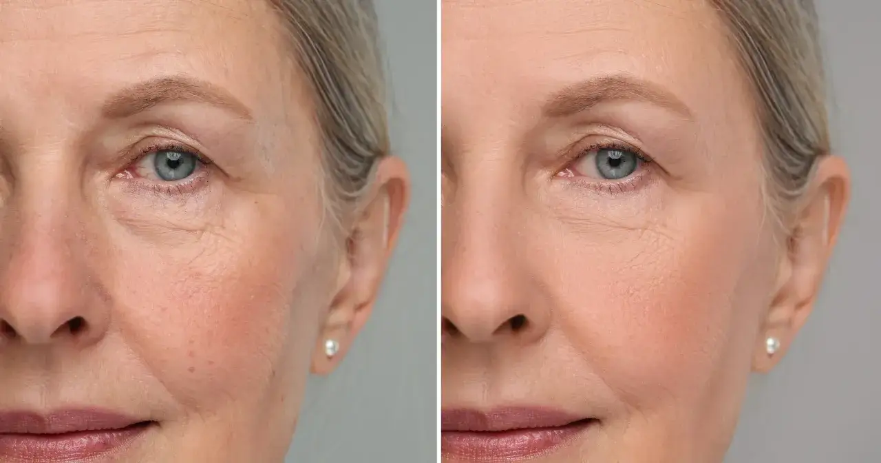 Porównanie skóry przed i po zabiegu. Widoczne wygładzenie zmarszczek, poprawa kolorytu. Czy to zasługa pullulan co to jest?