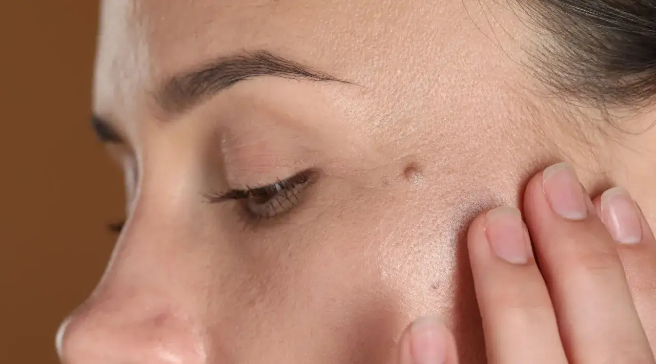 Zbliżenie na twarz z widocznym pieprzykiem, sugerujące rozważania o usuwaniu pieprzyków z twarzy.