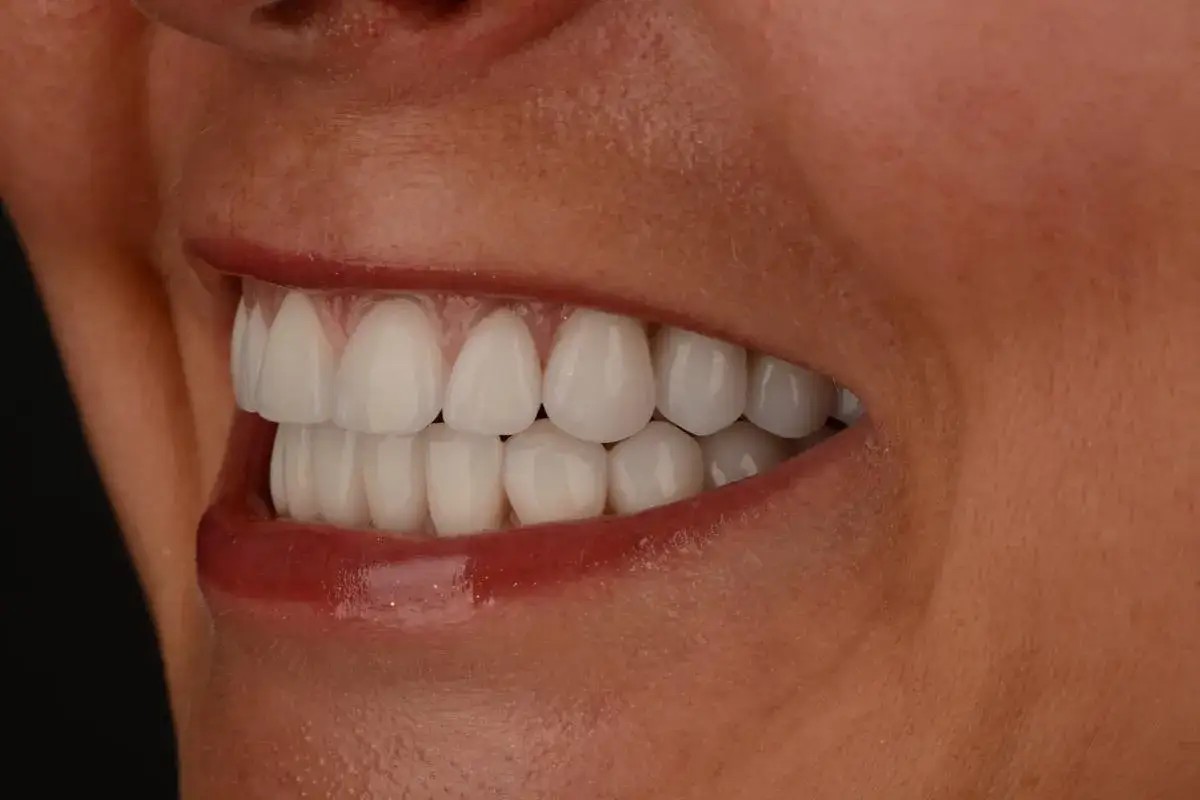 Ile trwa wybielanie zębów? Szybko czy tygodniami? Pełny przewodnik.